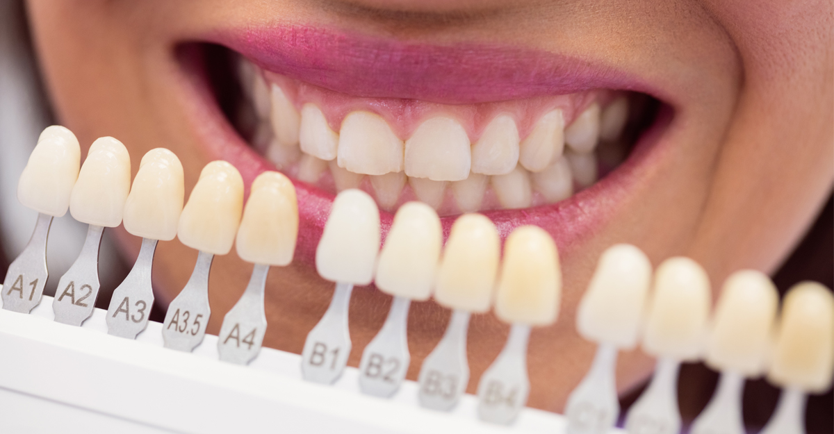 Teeth whitening